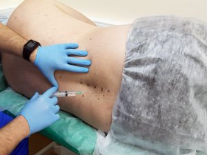 Блокада при боли в пояснице