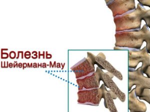 Болезнь Шейермана-Мау