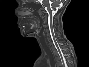 Мрт шейного отдела позвоночника фото