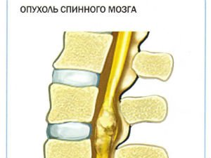 Опухоль спинного мозга