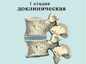 Остеохондроз 1 степени