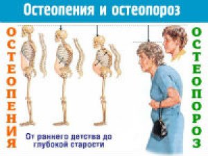 Остеопороз и остеопения
