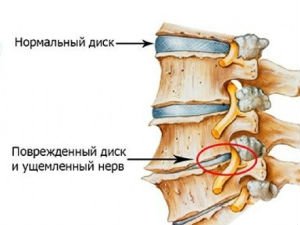Остеохондроз поясничного отдела фото