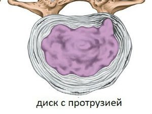 Протрузия межпозвонкового диска