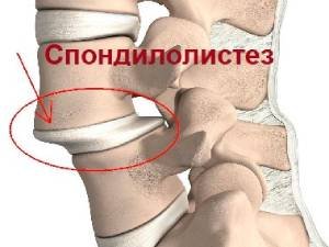 Спондилолистез