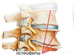 Деформирующий спондилез фото