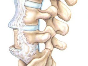 Спондилез поясничного отдела позвоночника фото
