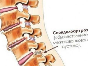Спондилоартроз позвоночника