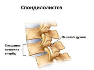 спондилолистез