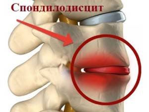 Спондилодисцит